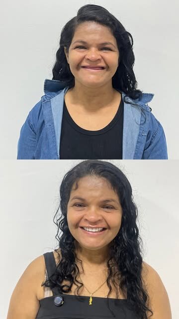 Paciente Dona Ednalva antes e depois do tratamento com dentes fixos