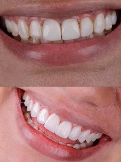 Sorriso com facetas em resina